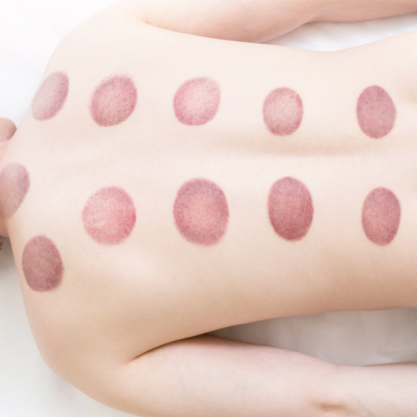 Well Set - You know those crazy 🔴 marks that come from cupping? Sneaky  fact… They're not actually bruises at all! Each mark is a result of your  blood being brought up